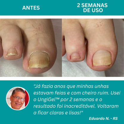 UngiGel - Adesivos para fungos