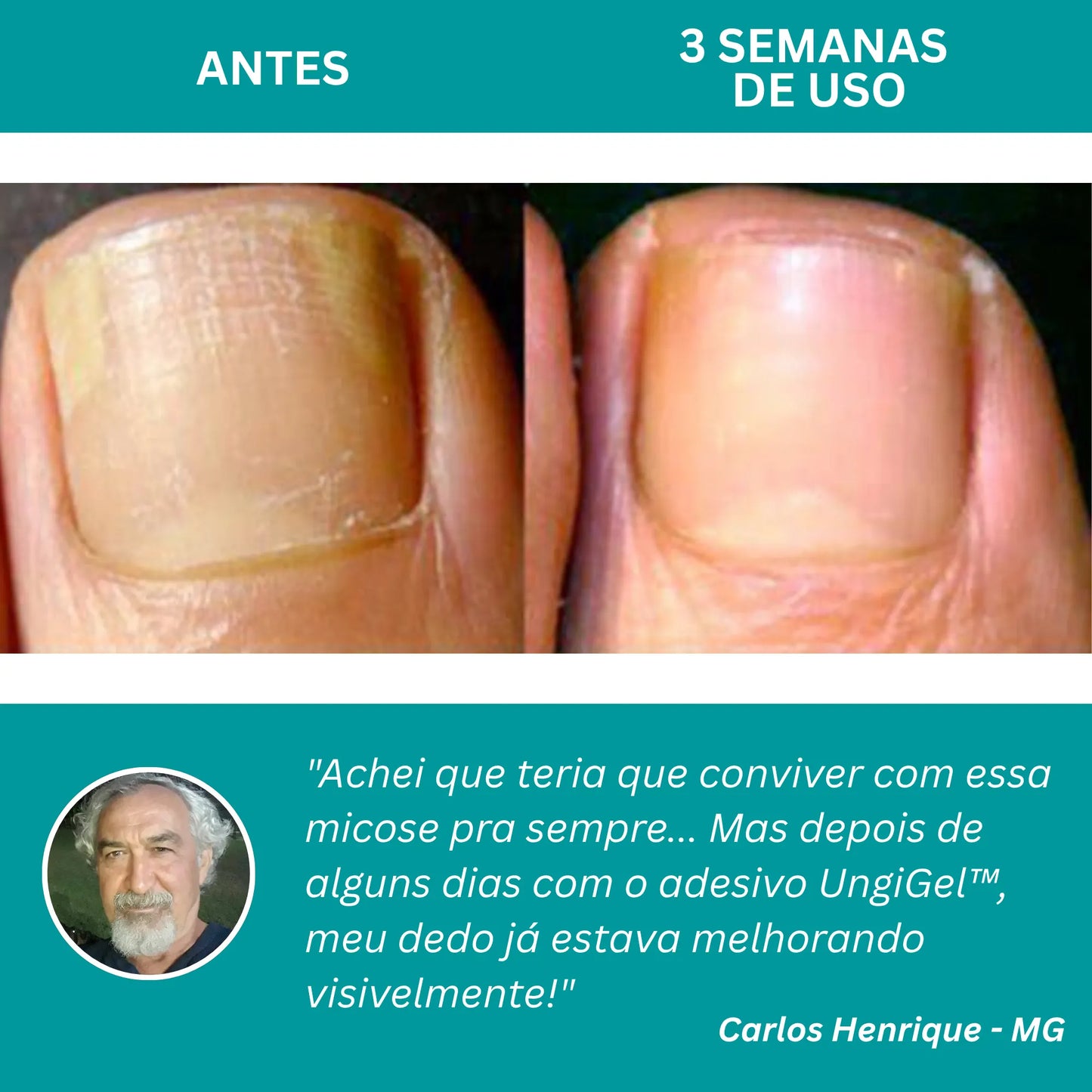 UngiGel - Adesivos para fungos