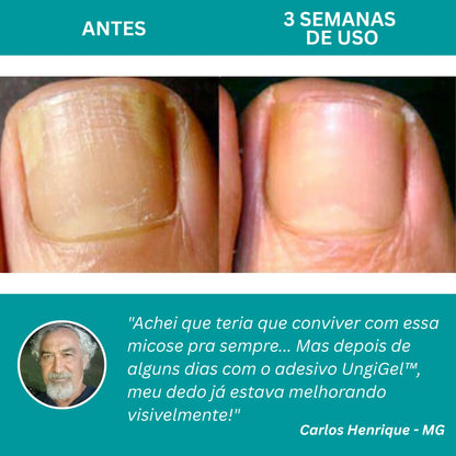 UngiGel - Adesivos para fungos