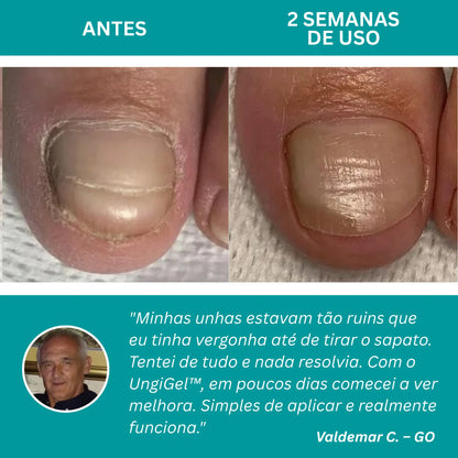 UngiGel - Adesivos para fungos