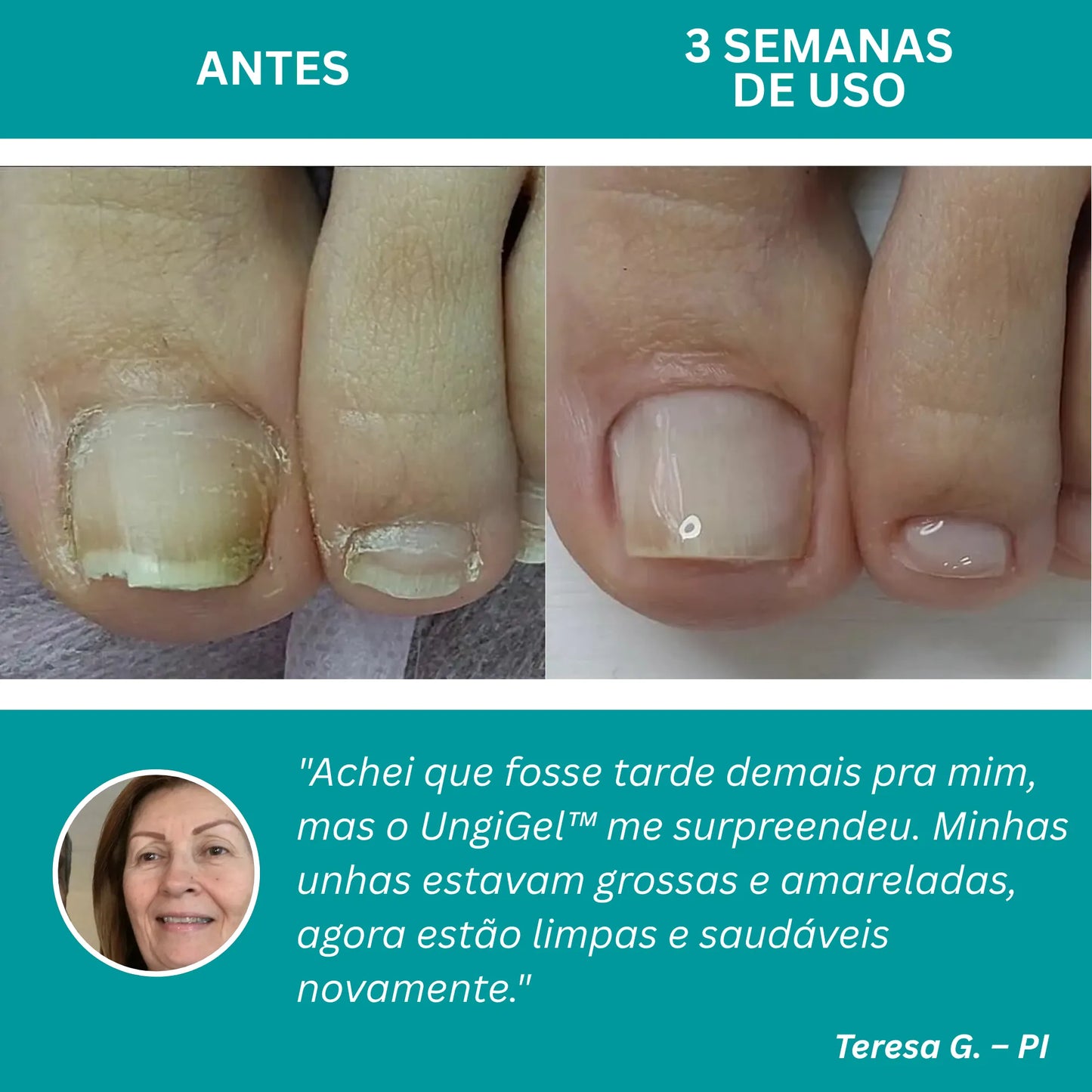 UngiGel - Adesivos para fungos