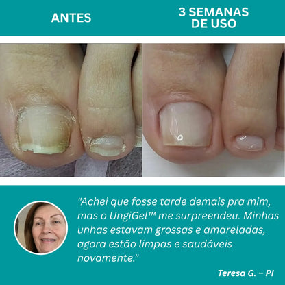 UngiGel - Adesivos para fungos