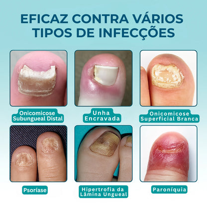 UngiGel - Adesivos para fungos